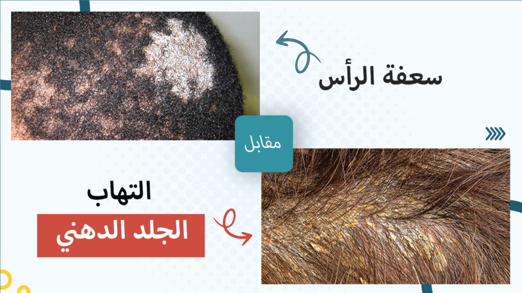 سعفة الرأس مقابل التهاب الجلد الدهني