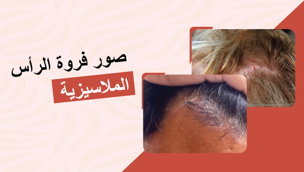 صور فروة الرأس الملاسيزية 
