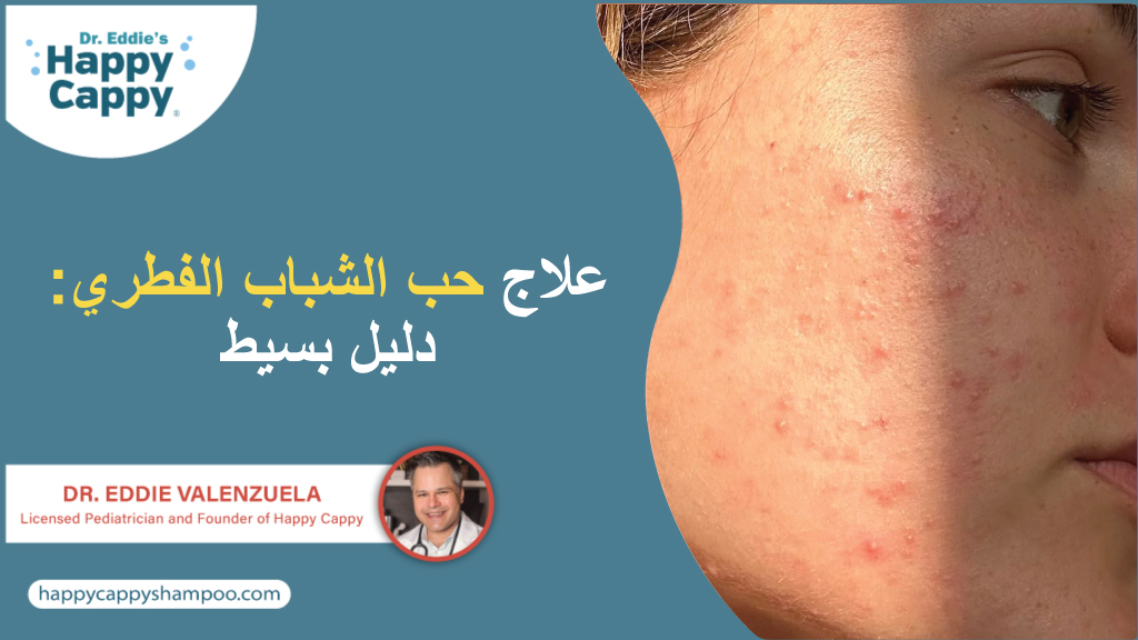 علاج حب الشباب الفطري: دليل بسيط