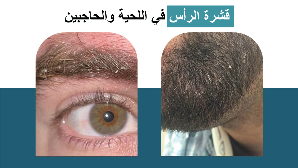 قشرة الرأس في اللحية والحاجبين