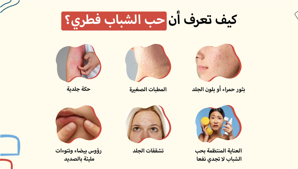 كيف تعرف أن حب الشباب فطري؟