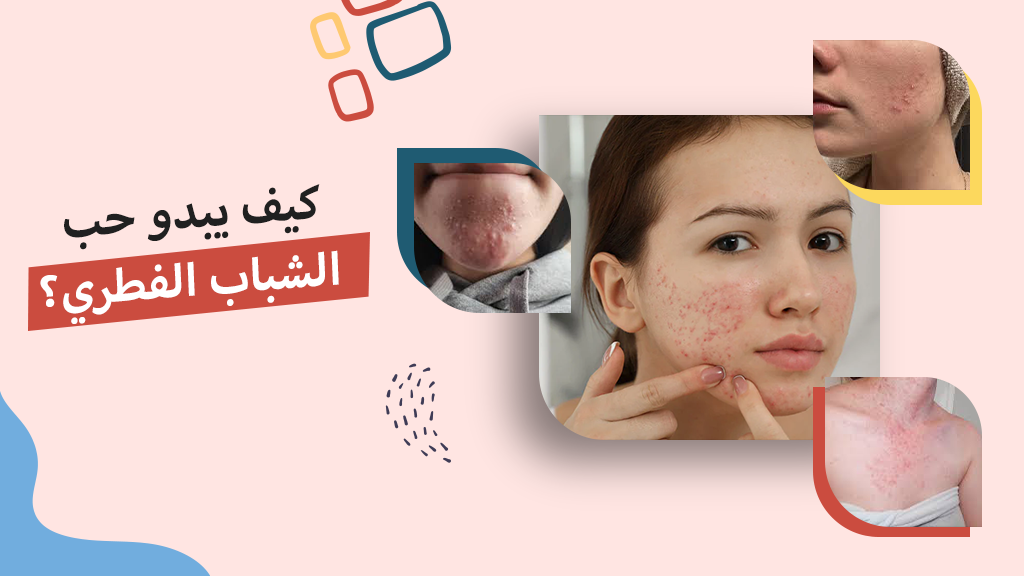 كيف يبدو حب الشباب الفطري؟