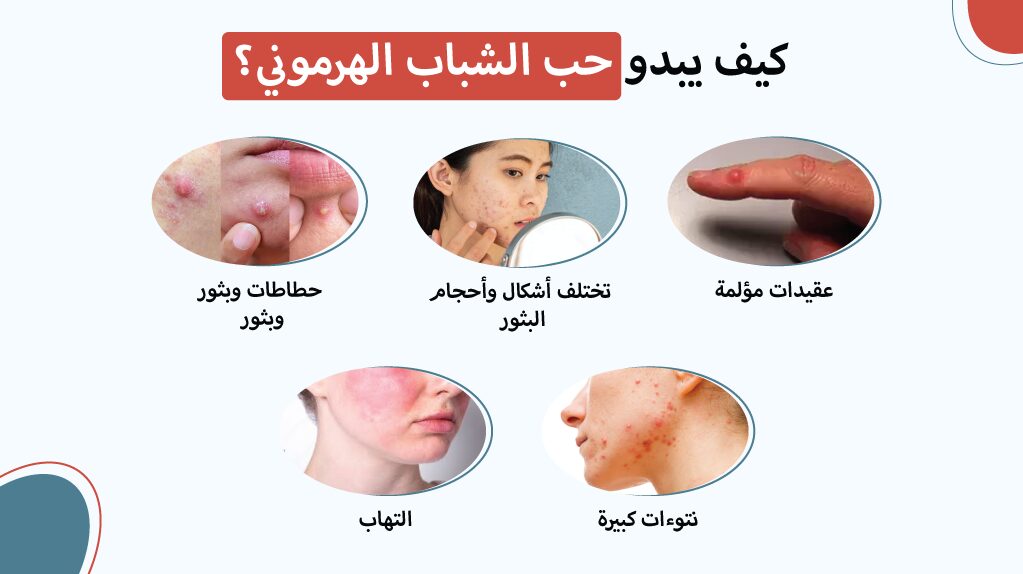 كيف يبدو حب الشباب الهرموني؟ كيف يبدو حب الشباب الهرموني؟