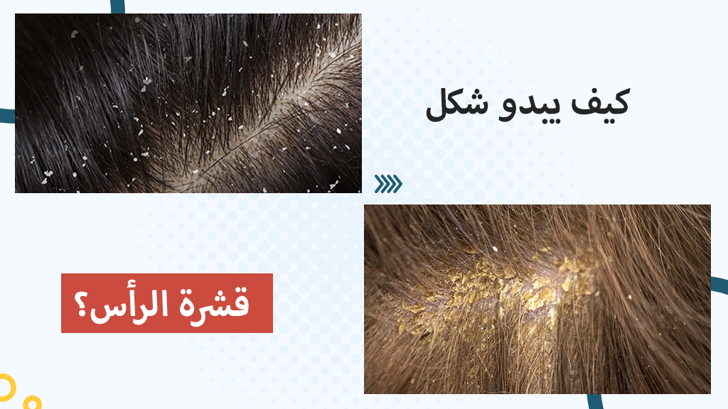 كيف يبدو شكل قشرة الرأس؟
