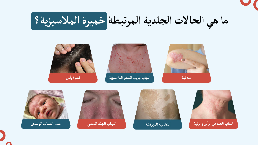ما هي الحالات الجلدية المرتبطة خميرة الملاسيزية؟