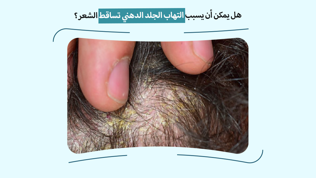 هل يمكن أن يسبب التهاب الجلد الدهني تساقط الشعر؟