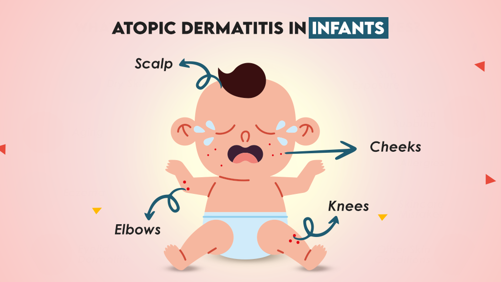 Atopic Dermatitis in Infants