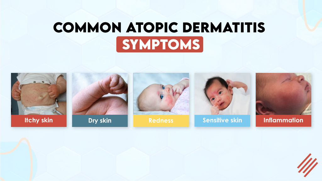 Common Atopic Dermatitis Symptoms