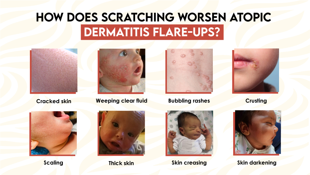 How Does Scratching Worsen Atopic Dermatitis Flare-Ups?