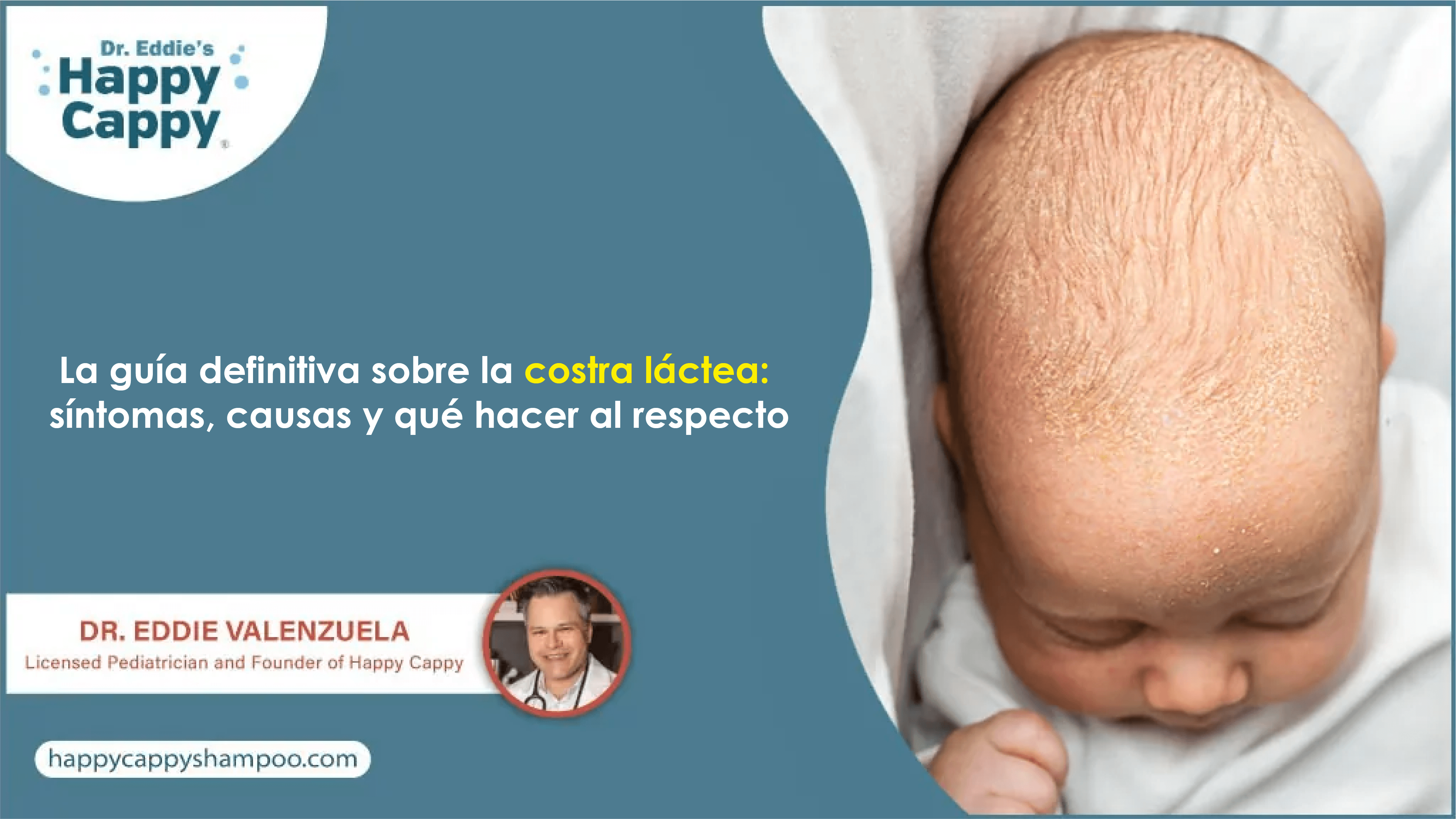 La guía definitiva sobre la costra láctea: síntomas, causas y qué hacer al respecto