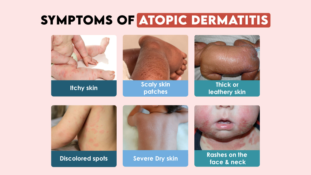 Symptoms of Atopic Dermatitis