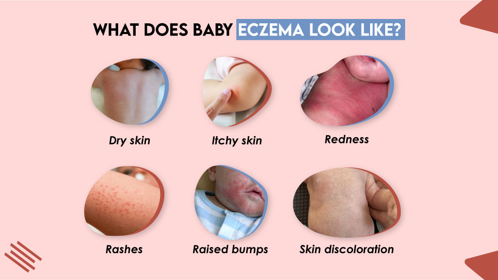 What Does Baby Eczema Look Like