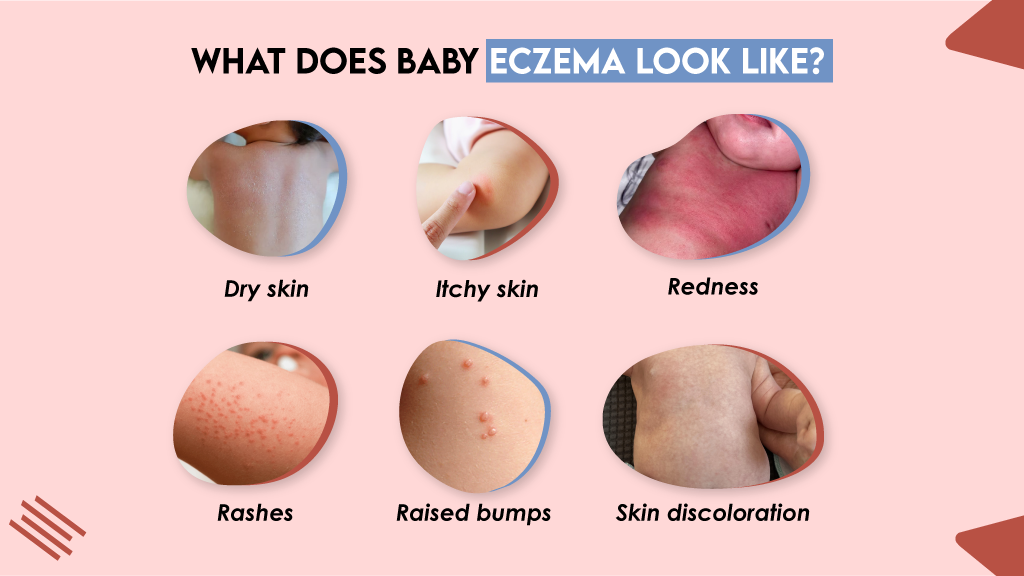 What Does Baby Eczema Look Like?