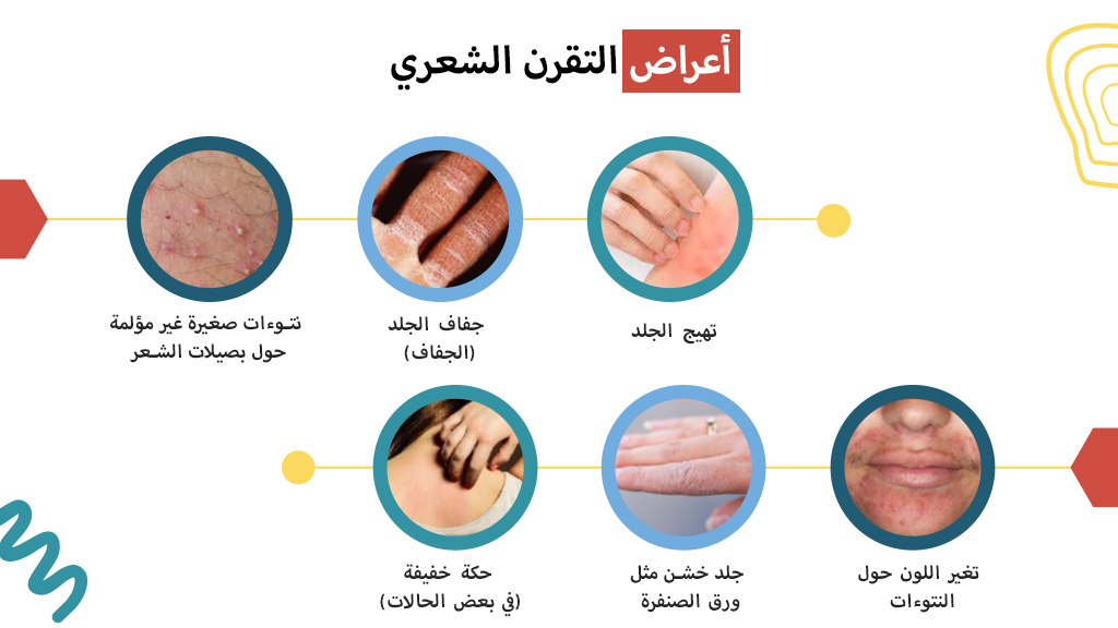 أعراض التقرن الشعري