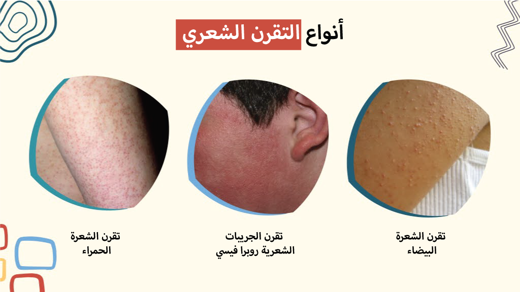 أنواع التقرن الشعري