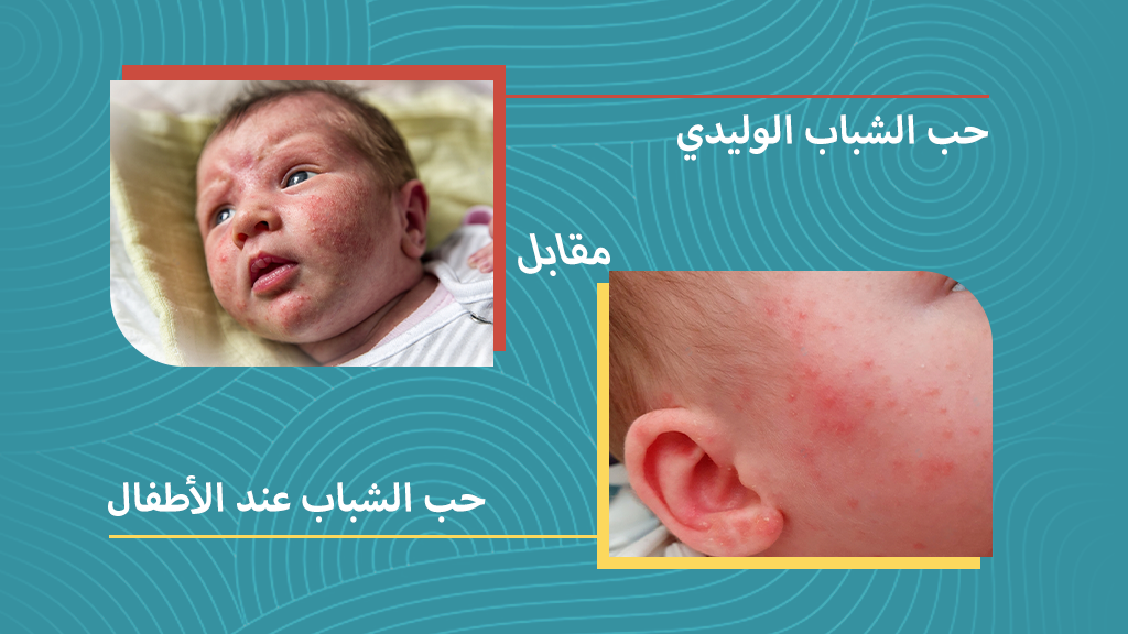 حب الشباب الوليدي مقابل حب الشباب عند الرضع