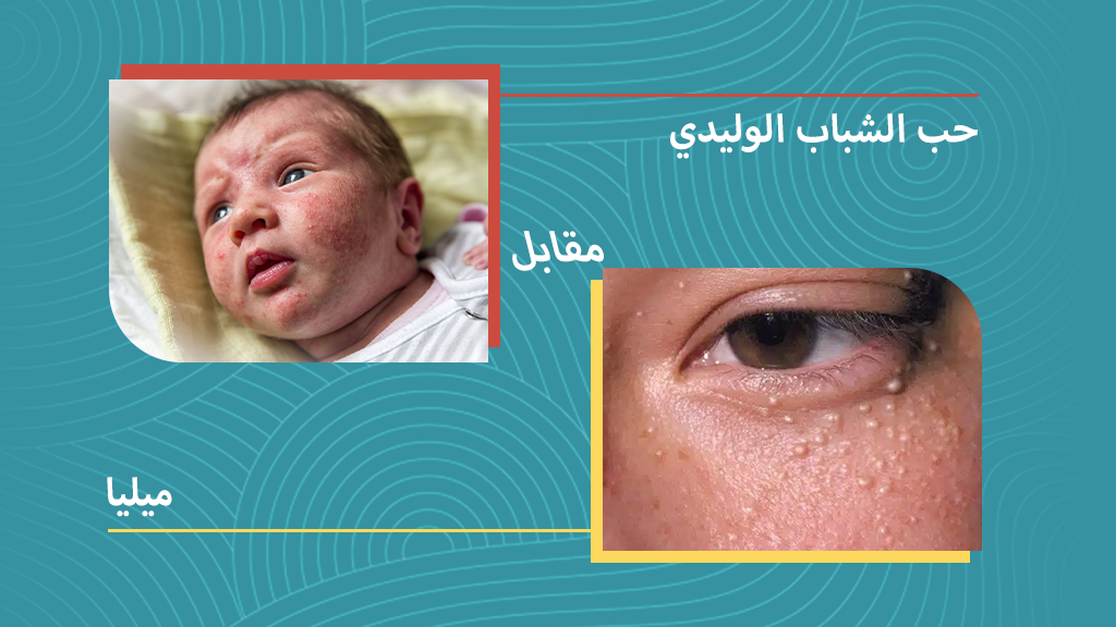 حب الشباب الوليدي مقابل ميليا