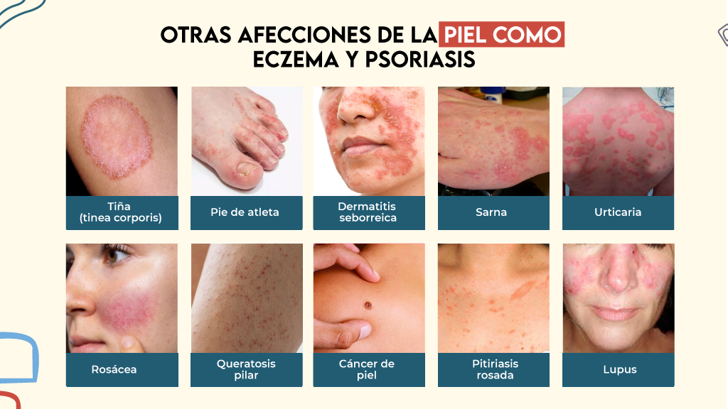 Otras Afecciones de la Piel Como Eczema y Psoriasis