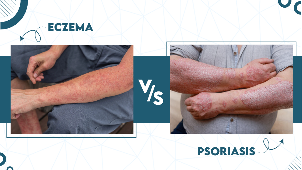 Imágenes de eczema vs psoriasis