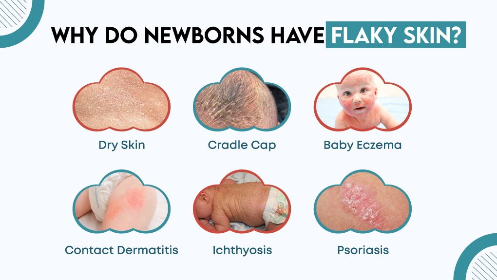 Why Do Newborns Have Flaky Skin? 6 Common Causes (Dry Skin, Cradle Cap, Eczema & More).