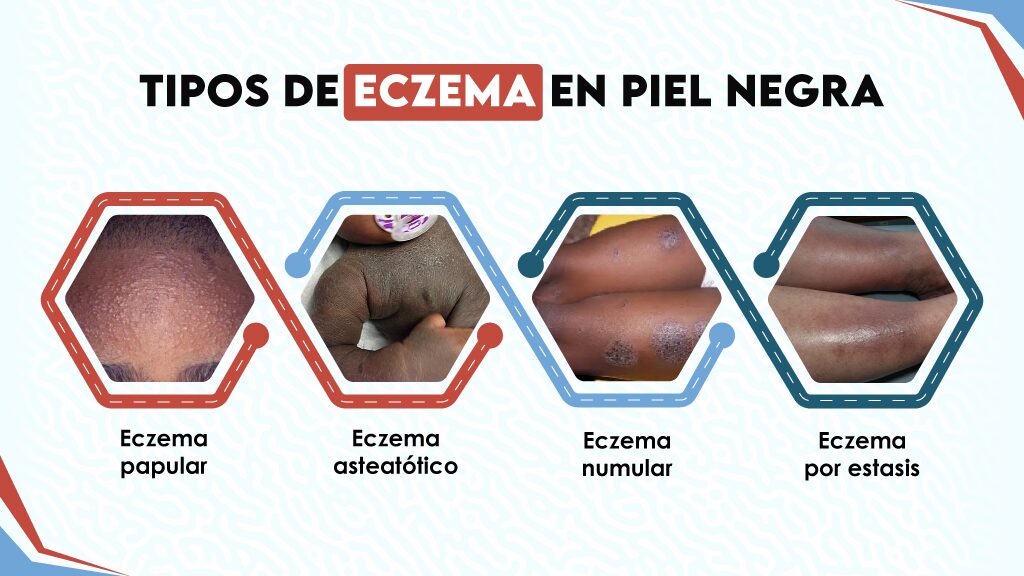 Tipos de eczema en piel negra