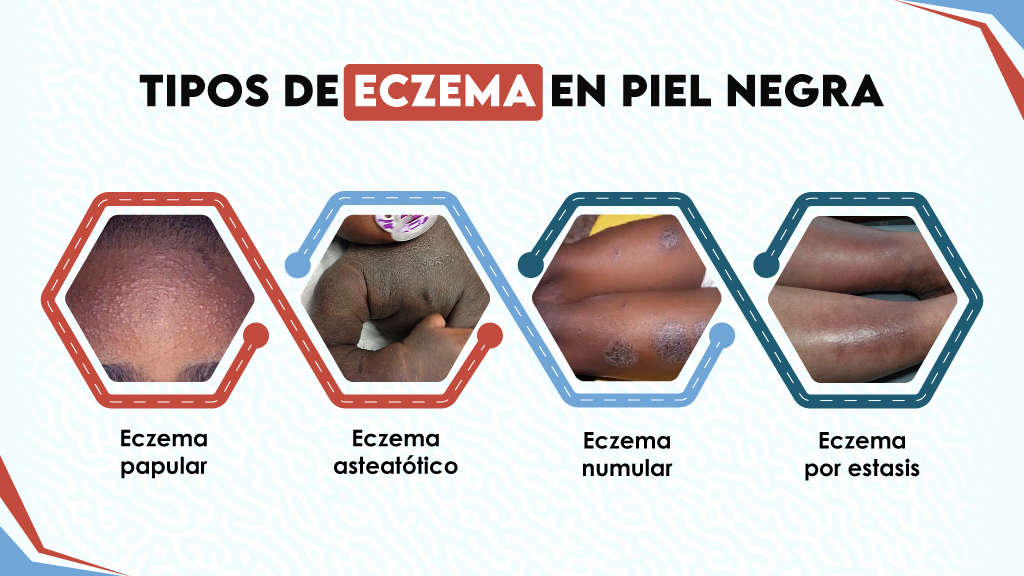 Tipos de eczema en piel negra