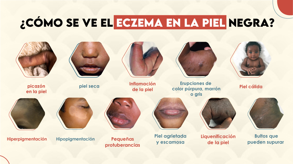 ¿Cómo se ve el eczema en la piel negra?