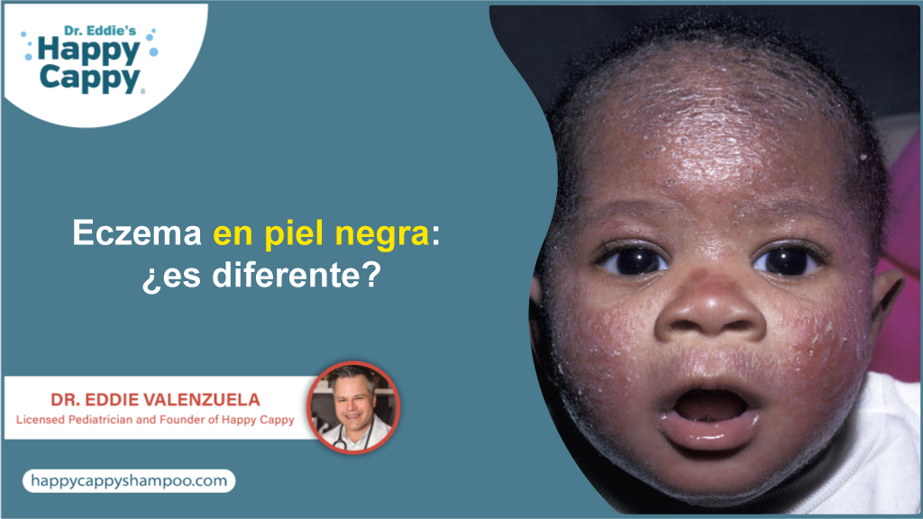 Eczema En Piel Negra: ¿Es Diferente?
