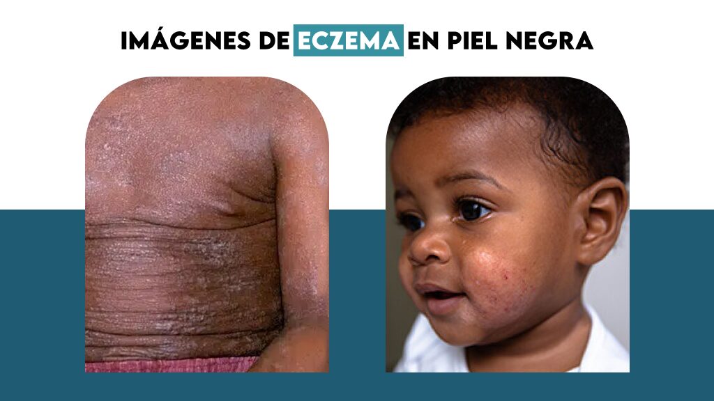 Imágenes de eczema en piel negra