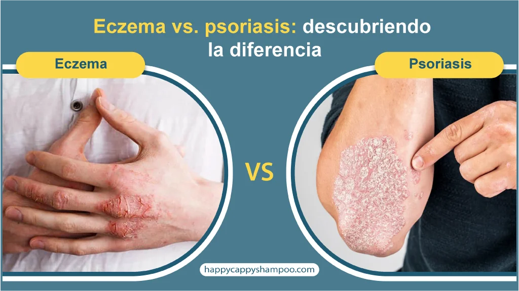 Eczema vs. Psoriasis: Ddescubriendo la Diferencia