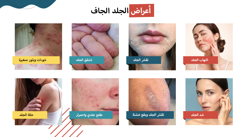 أعراض الجلد الجاف