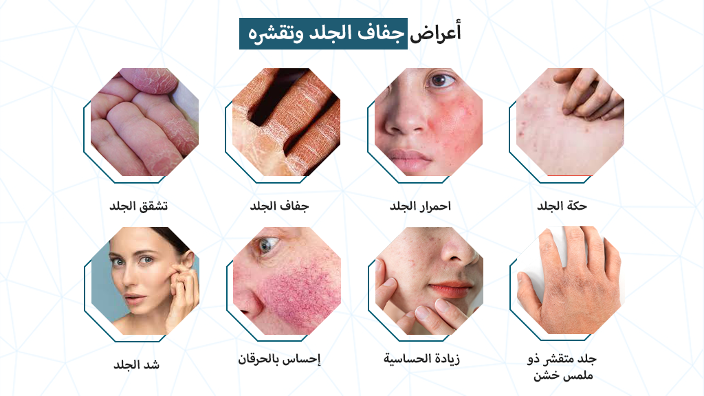 أعراض جفاف الجلد وتقشره