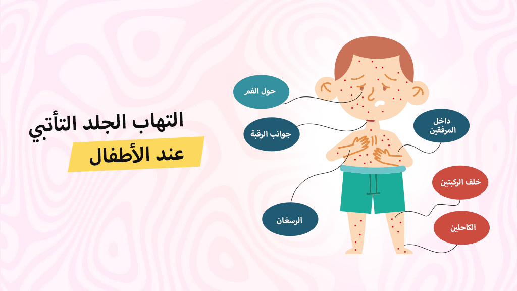 التهاب الجلد التأتبي عند الأطفال