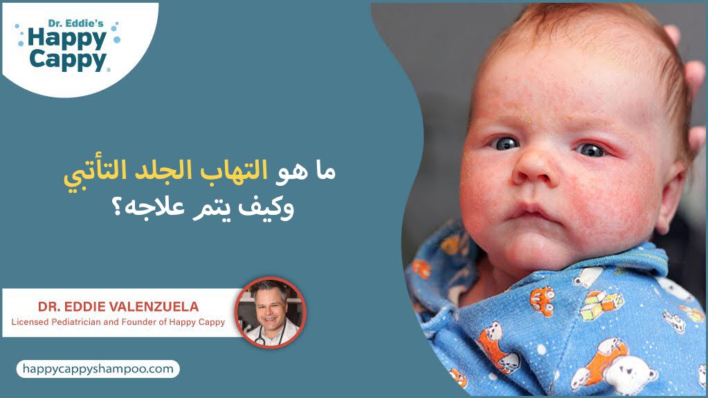 ما هو التهاب الجلد التأتبي وكيف يتم علاجه؟