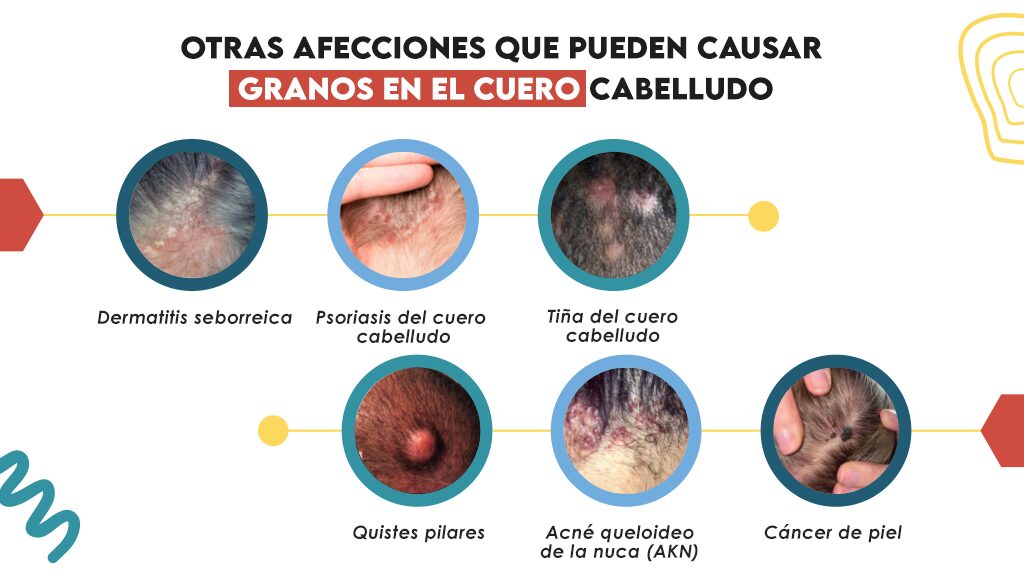 Otras afecciones que pueden causar granos en el cuero cabelludo