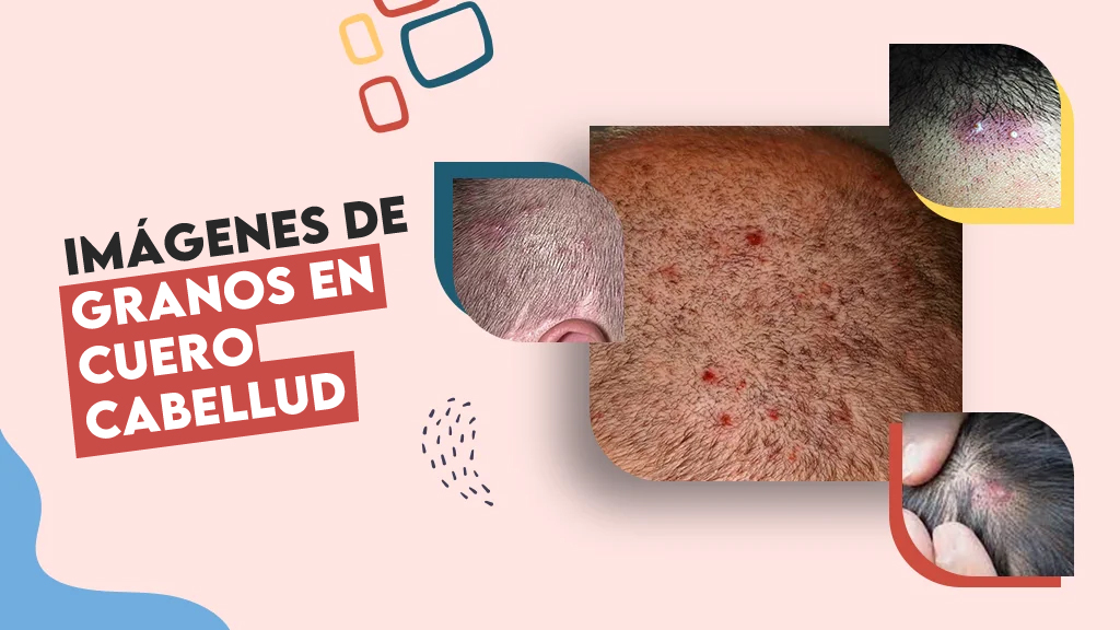 Imágenes de granos en cuero cabelludo