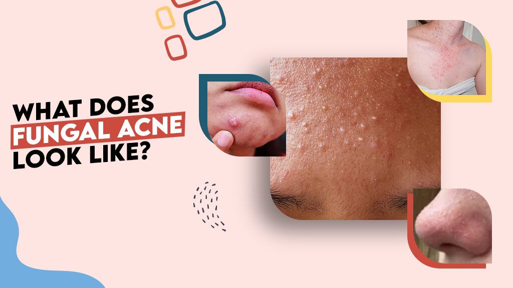 What Does Fungal Acne Look Like?