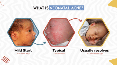 Neonatal Acne Baby Acne Symptoms Causes And Treatment neonatal-acne-baby-acne-symptoms-causes-and-treatment