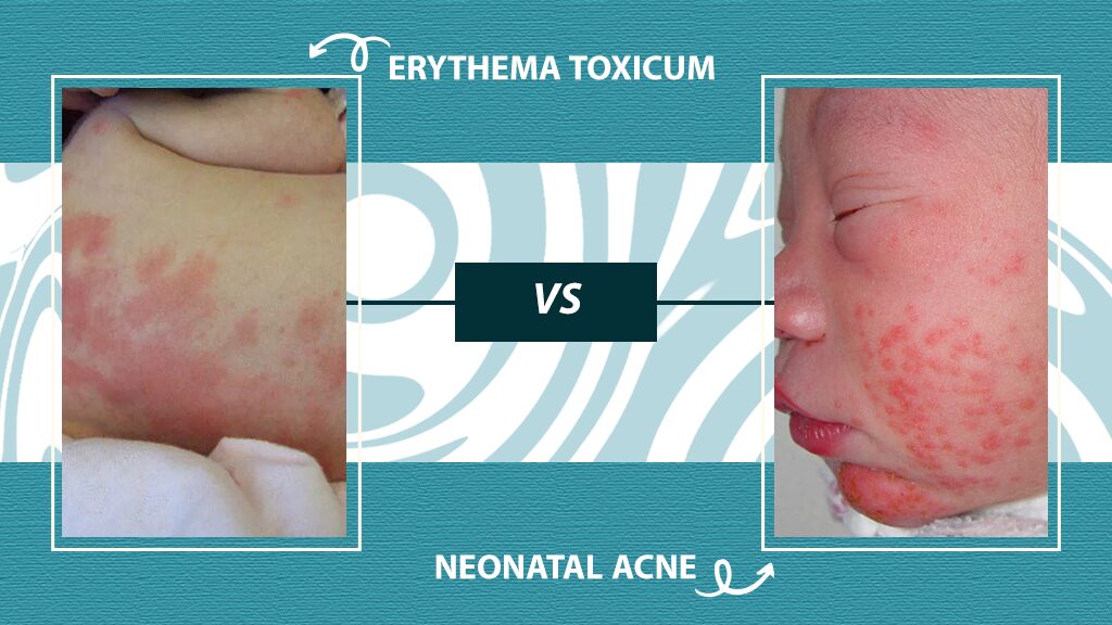 Erythema Toxicum vs Neonatal Acne