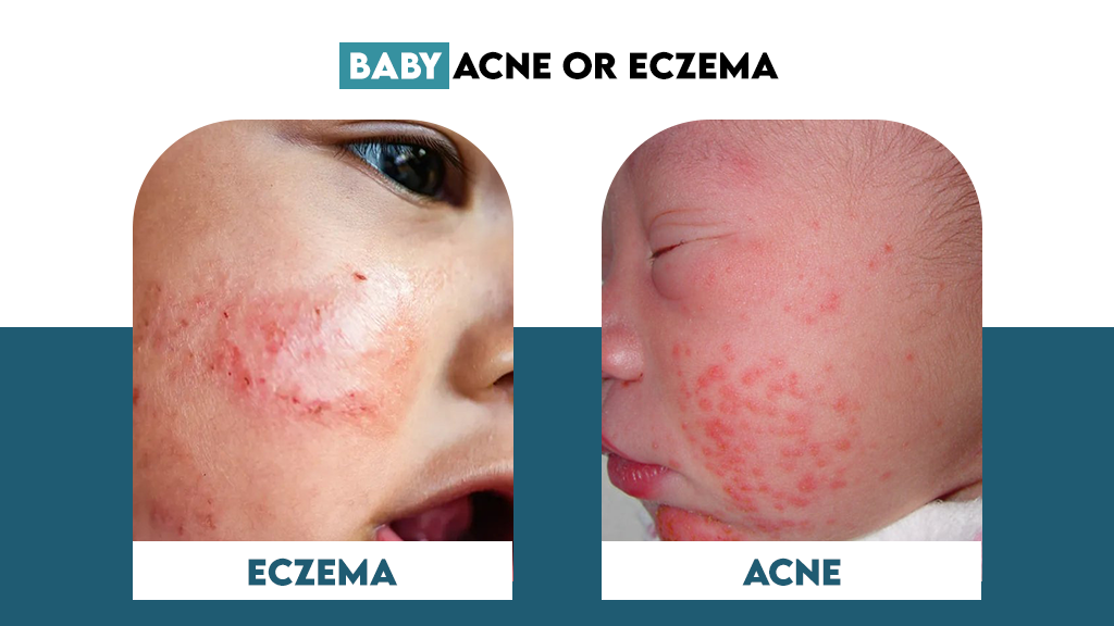 Baby Acne or Eczema