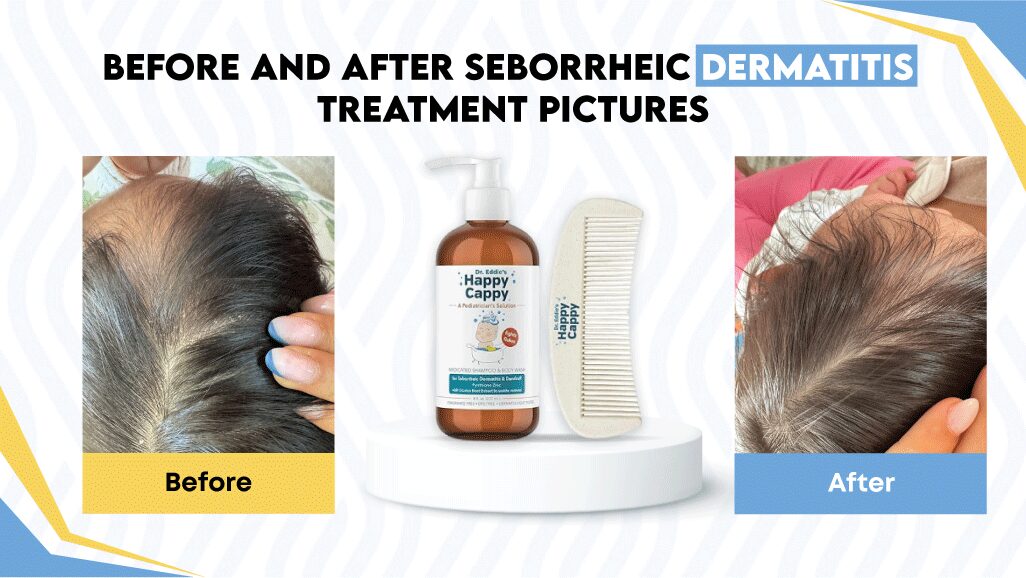 Best Seborrheic Dermatitis Shampoo