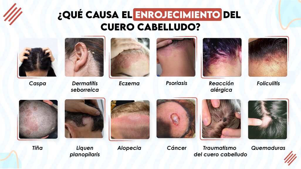 ¿Qué causa el enrojecimiento del cuero cabelludo?