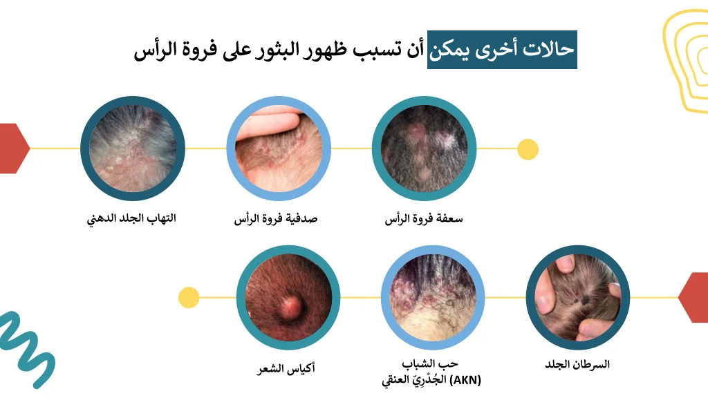حالات أخرى يمكن أن تسبب ظهور البثور على فروة الرأس