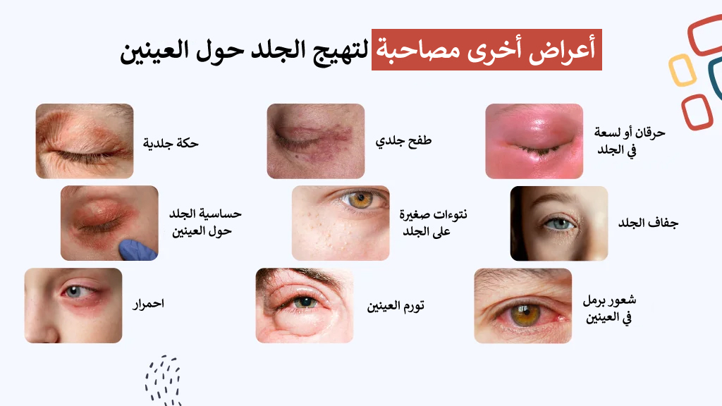 أعراض أخرى مصاحبة لتهيج الجلد حول العينين