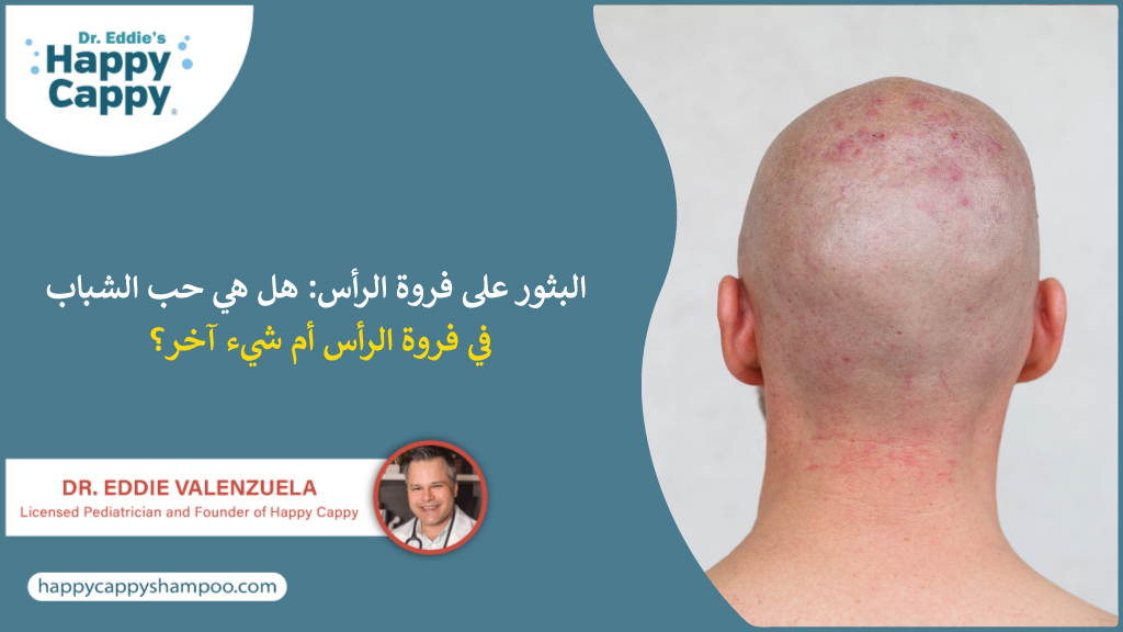 البثور على فروة الرأس: هل هي حب الشباب في فروة الرأس أم شيء آخر؟
