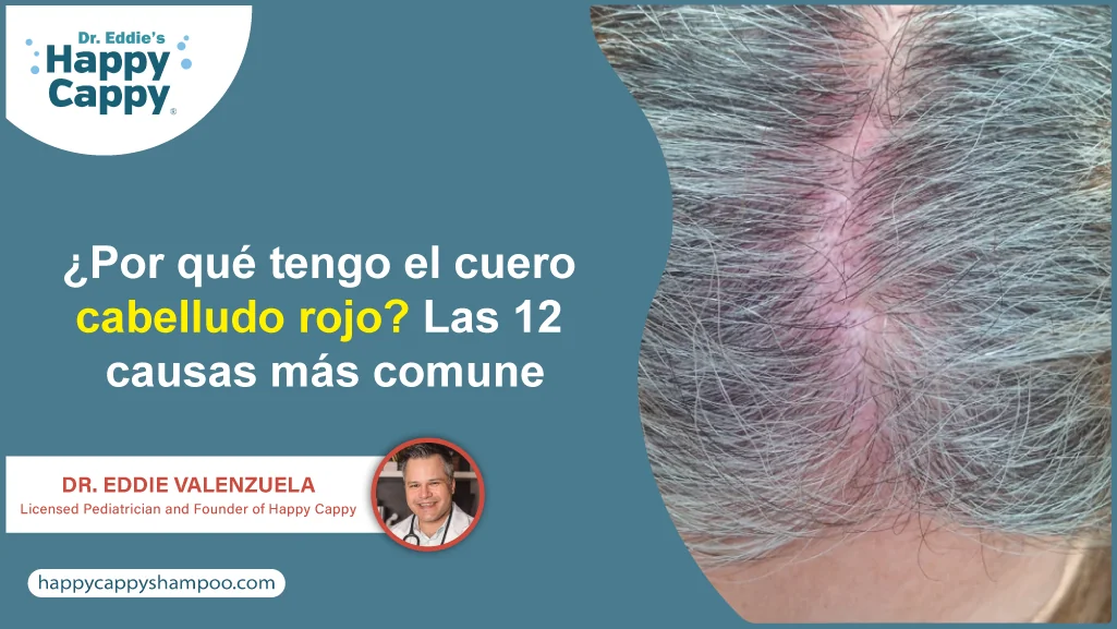 ¿Por qué tengo el cuero cabelludo rojo? Las 12 causas más comune
