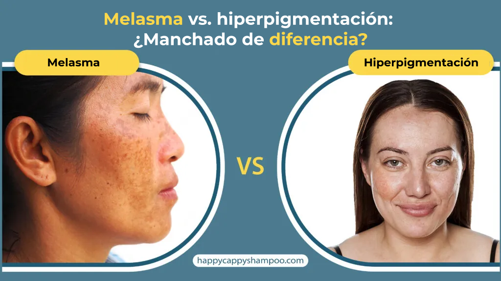 Melasma vs hiperpigmentación