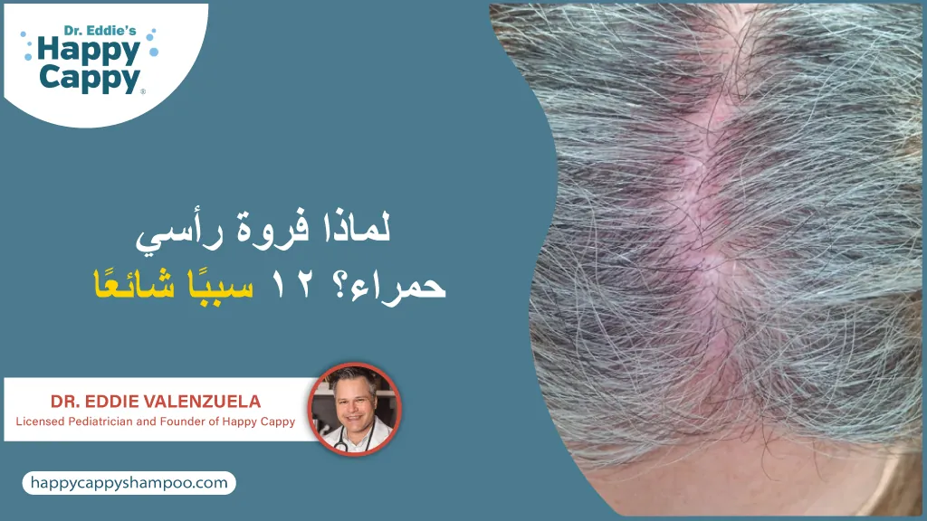 لماذا فروة رأسي حمراء؟ ١٢ سببًا شائعًا