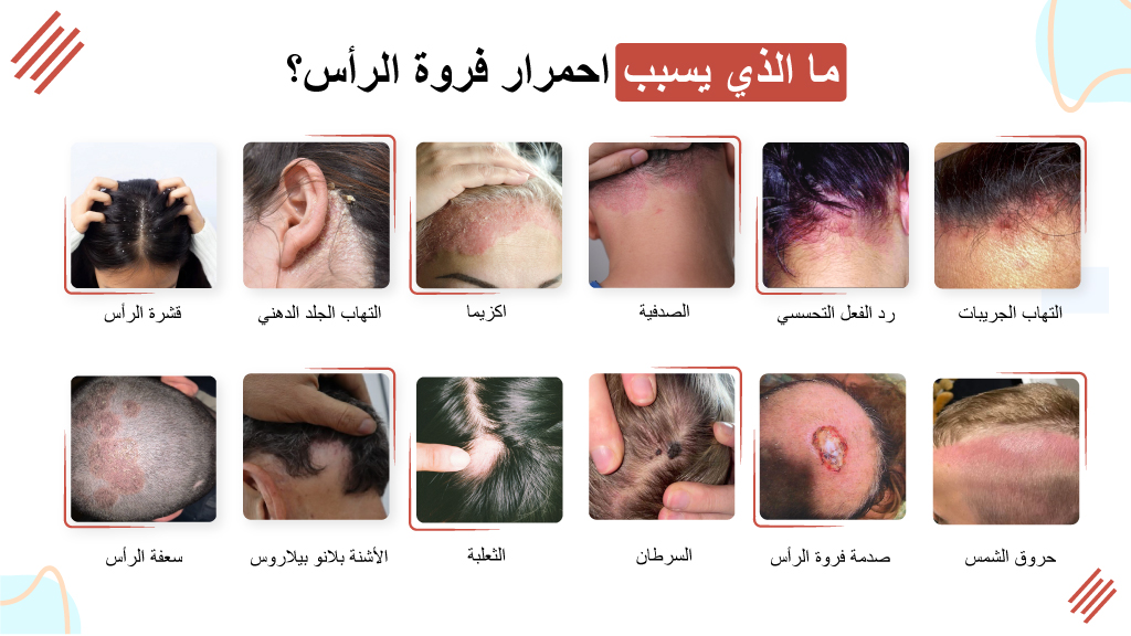 ما الذي يسبب احمرار فروة الرأس؟