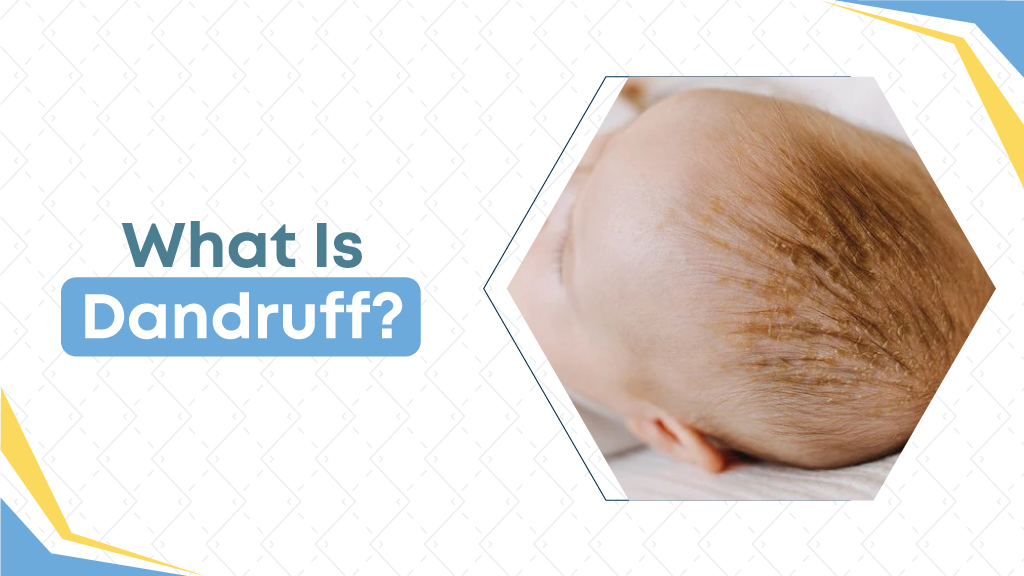 What Is Dandruff?